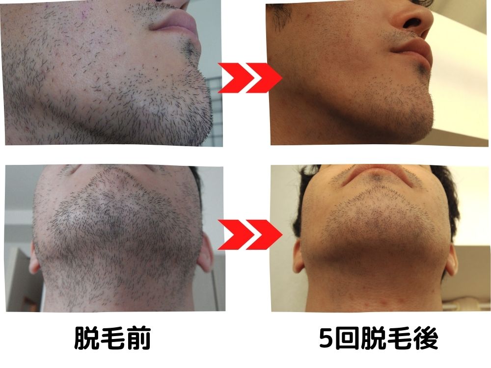 メンズリゼ広島院でヒゲ脱毛5回コースを受けたビフォーアフター！ ｜ 広島スターストック